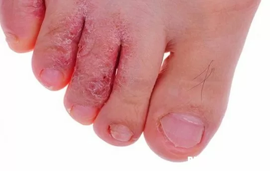 Những sai lầm thường gặp khi chữa nước ăn chân