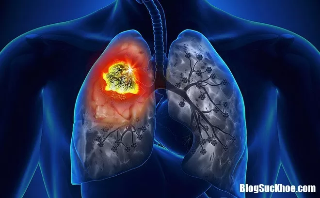 Vì sao phụ nữ không hút thuốc lá vẫn bị ung thư phổi ?