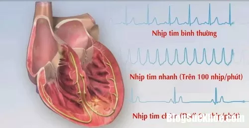 Dùng thuốc chữa liệt dạ dày có nguy cơ bị bệnh tim mạch