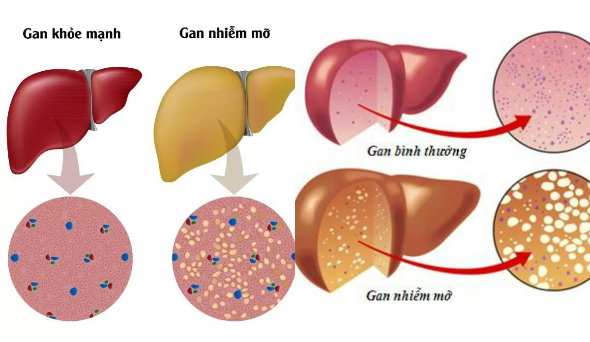 Những yếu tố nguy cơ gây bệnh gan nhiễm mỡ