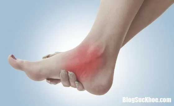 Hướng dẫn cách chữa bong gân và làm giảm cơn đau do bong gân gây ra