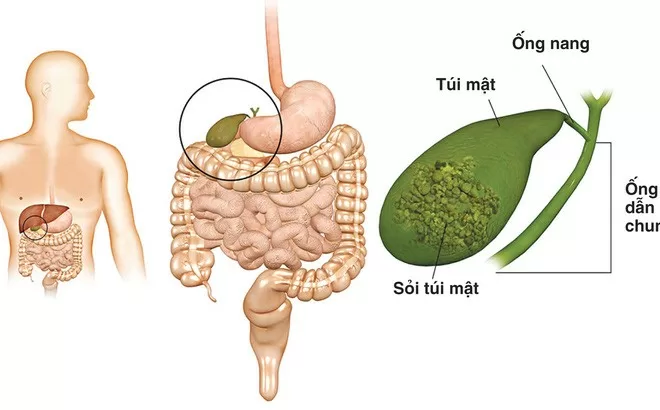 Những triệu chứng bất thường cảnh báo túi mật có vấn đề