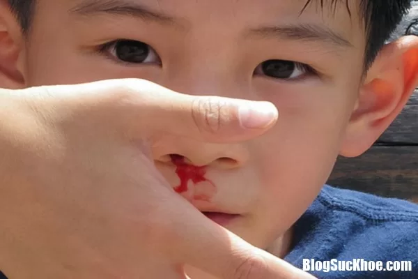 Làm gì khi bị chảy máu cam?