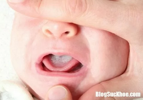 Nguyên nhân gây bệnh nấm lưỡi ở trẻ