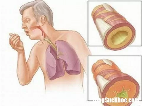 Những biểu hiện ban đầu của bệnh ung thư phổi