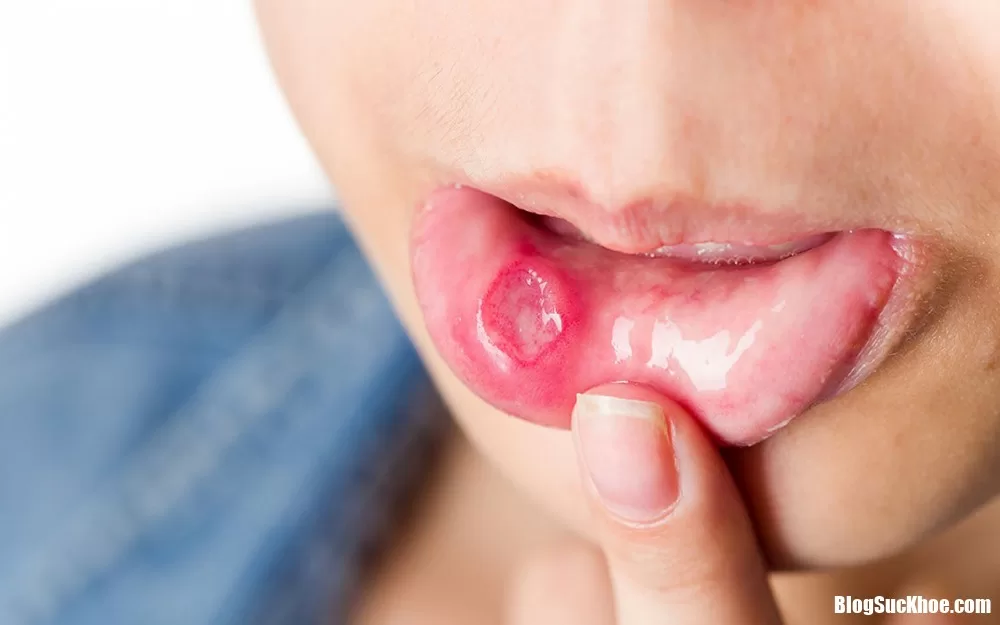 Những dấu hiệu cảnh báo sớm của ung thư cần đi khám ngay