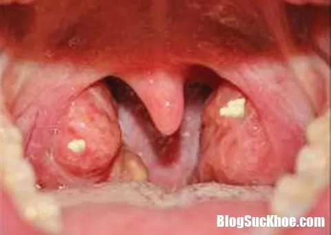 Viêm amiđan hốc mủ dễ tái phát khi thời tiết thay đổi đột ngột