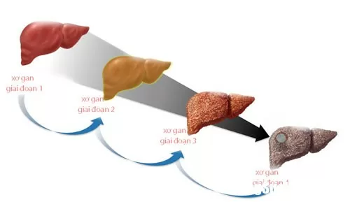 Cách dùng thuốc nam điều trị bệnh xơ gan