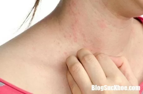 Da bị dị ứng - nguyên nhân và cách phòng ngừa