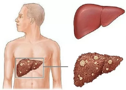 Phương pháp mới điều trị ung thư gan tiên tiến