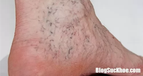 Giáo viên, dân văn phòng dễ mắc chứng suy tĩnh mạch ở chân