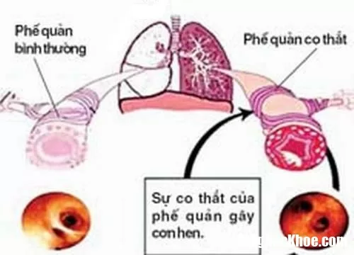 Những lưu ý bệnh hen khi trời chuyển rét