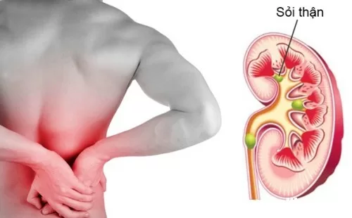 Khi bị sỏi thận thì nên tránh xa những thực phẩm này