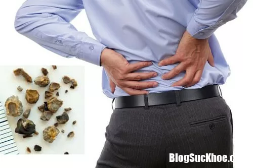 Những người nào có nguy cơ mắc sỏi thận?