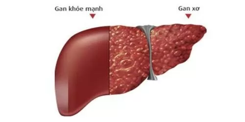 Men gan tăng cao cảnh báo sức khỏe đang đi xuống