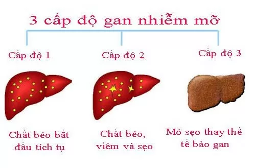 Gan nhiễm mỡ nguy hiểm nhưng nhiều người vẫn thờ ơ