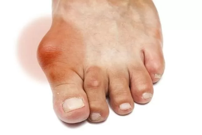 Công dụng chữa bệnh gout của lá tía tô