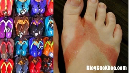 Những nguy hại sức khỏe của việc đi dép tông