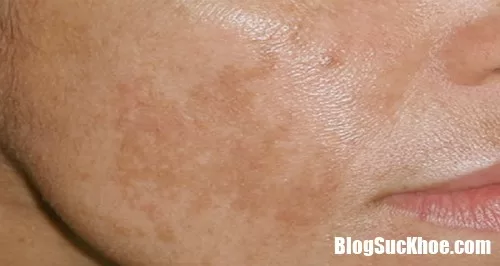 Những thủ phạm gây tăng sắc tố da vùng mặt