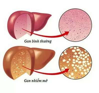 Những bệnh dễ mắc thường gặp nhất ở gan
