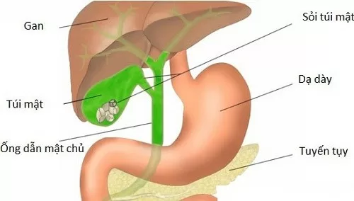 Cách chữa sỏi mật đơn giản không cần phẫu thuật
