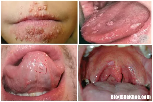 Những dấu hiệu cho biết bạn đã mắc bệnh sùi mào gà nên đi khám ngay