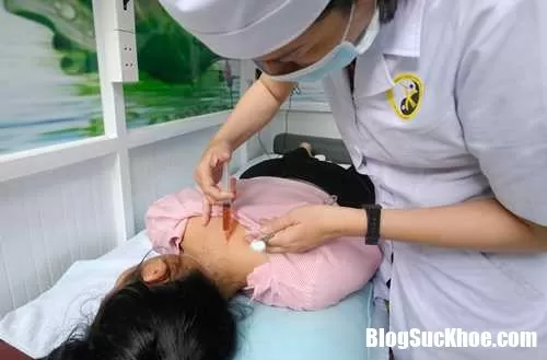Cách châm cứu kết hợp tiêm thuốc chữa đau đầu
