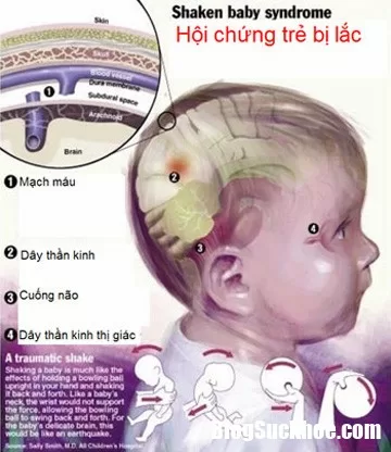 Những tổn thương trẻ có thể gặp phải nếu cứ rung lắc mạnh