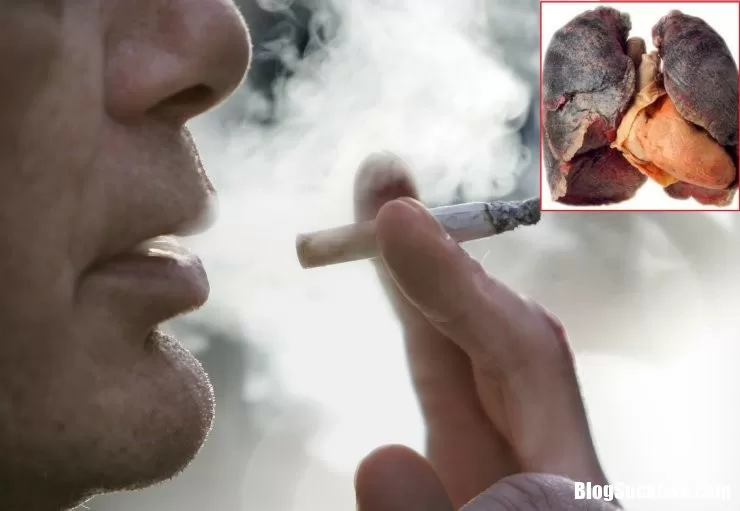 Ung thư phổi ngày càng tăng nhanh chỉ sau ung thư gan