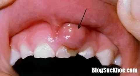 Những thói quen gây ung thư khoang miệng