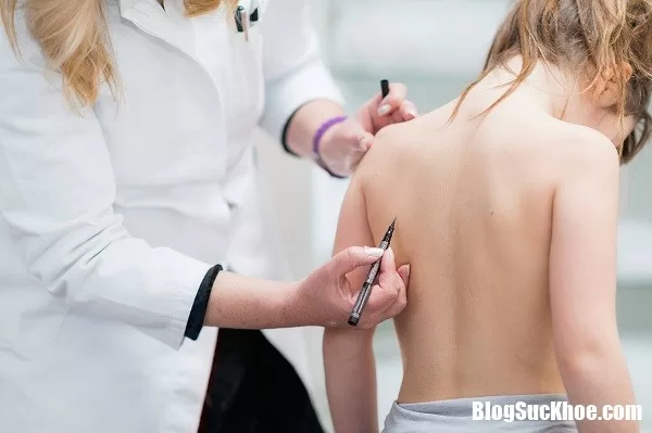 Những lưu ý về cột sống bị cong vẹo