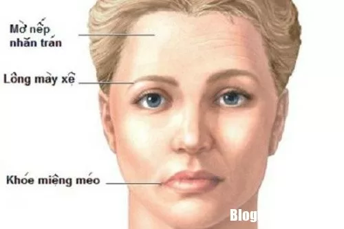 Mùa thu đông cần cảnh giác với căn bệnh liệt nửa mặt