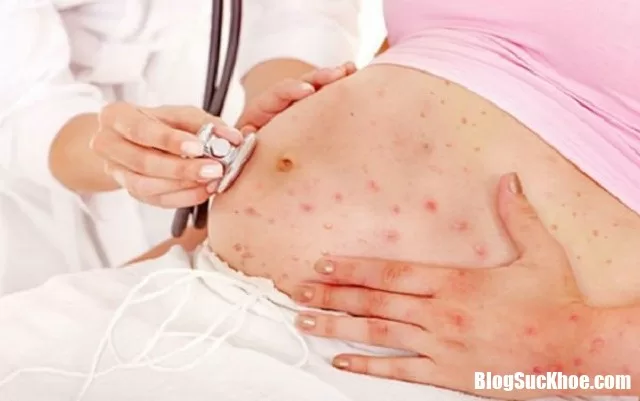 Bà bầu cần lưu ý tiêm phòng những loại vaccin nào ?
