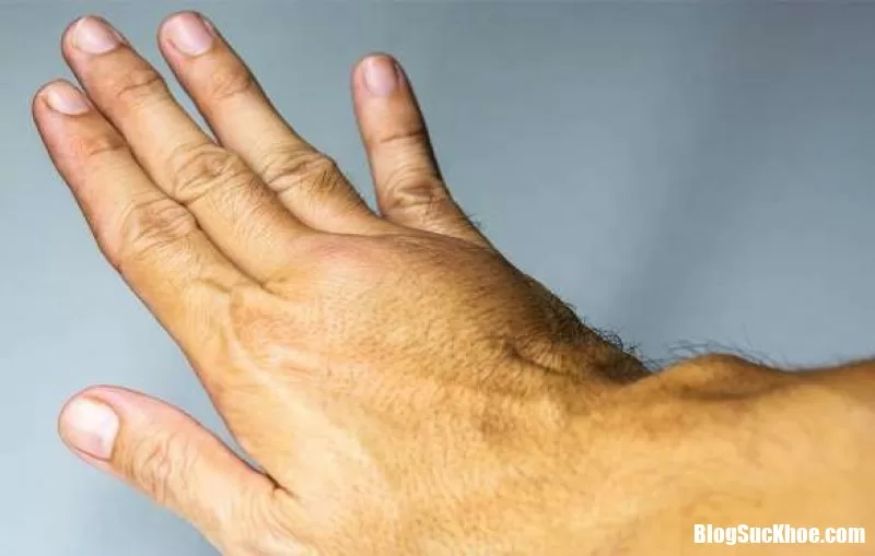6 Dấu hiệu dễ bị bỏ qua cảnh báo cơ thể có cục máu đông