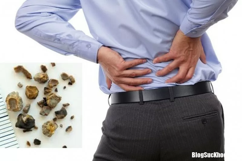 Những biến chứng nguy hiểm của bệnh sỏi thận