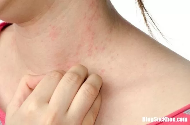 Mùa hanh khô da dễ bị bệnh gì nhất ?