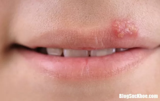 Lở rộp môi khi trời lạnh là bệnh gì ?