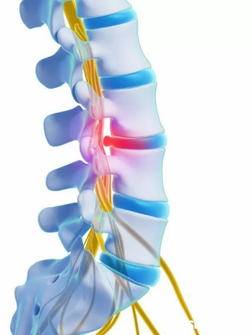 Thoát vị đĩa đệm và những biến chứng nguy hiểm