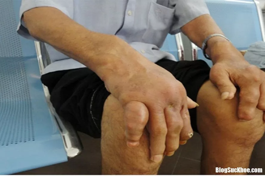Những việc nên làm khi mắc bệnh gout