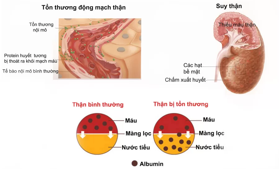 Dấu hiệu cho thấy thận đang gặp vấn đề cần phải thanh lọc