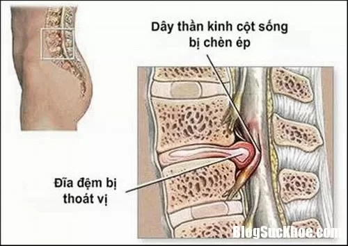 Thoát vị đĩa đệm cột sống thắt lưng cần điều trị sớm để ngăn ngừa biến chứng