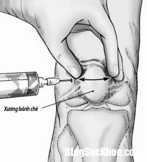 Sai lầm trong chữa thoái hóa khớp gối khiến bệnh càng nặng thêm