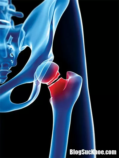 Bệnh loãng xương và những biến chứng vô cùng nguy hiểm
