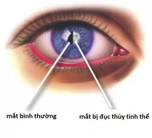 Nhận biết bệnh cườm mắt ở người già