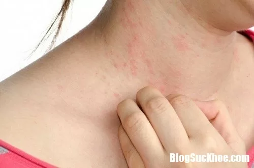 Cách trị bệnh và phòng tránh bệnh dị ứng thời tiết