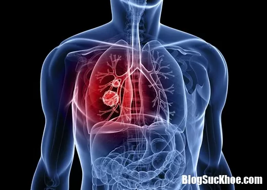 Cách chăm sóc giúp kéo dài sự sống cho người bị bệnh ung thư phổi