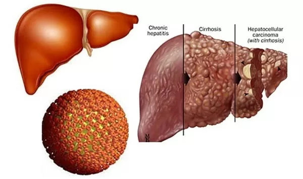 Những điều chưa biết về bệnh viêm gan B