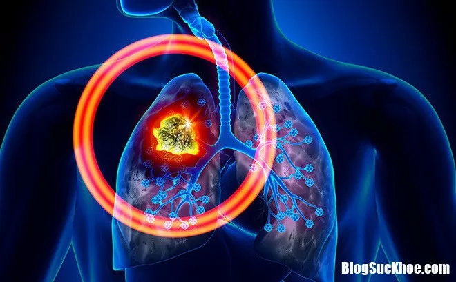 Cách phân biệt đau vai do ung thư phổi với đau vai của dân văn phòng