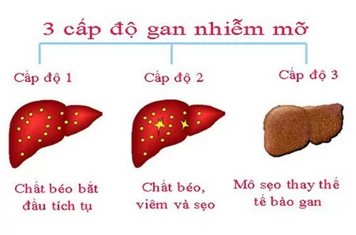 Cách dùng thuốc điều trị gan nhiễm mỡ hiệu quả