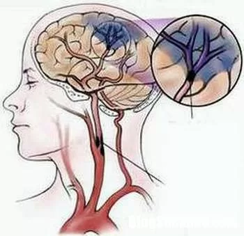 Cứu đột quỵ cần lưu ý đến 'giờ vàng'
